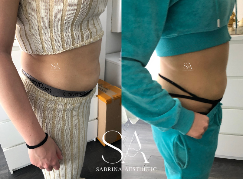 LIPO im